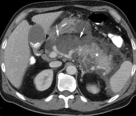 Imaging Assessment of Etiology and Severity of Acute Pancreatitis ...