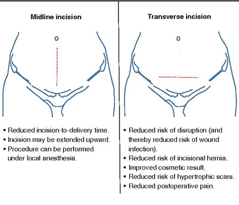 A Supraumbilical Transverse Incision