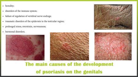 causes psoriasis genitals | Psoriasis expert