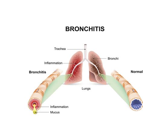 Acute bronchitis Guide: Causes, Symptoms and Treatment Options