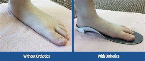 Benefits of Custom Orthotics I Alpine Foot Specialists