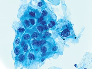 Cytopathology in Focus: The evolving management of LSIL in Pap tests ...