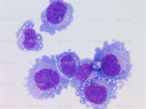 Malignant Cells Peritoneal Fluid