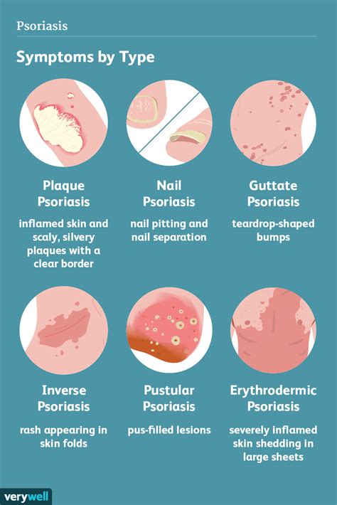 Symptômes du psoriasis - Fmedic