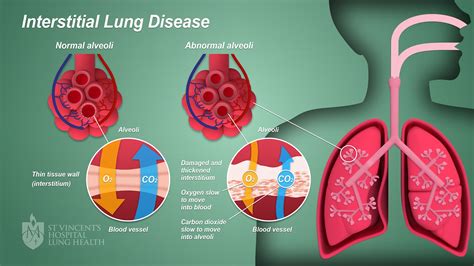 Interstitial Lung Disease : Life Expectancy, Treatment, and Types