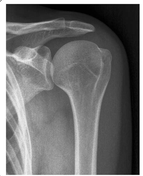 Greater Tubercle Of Humerus