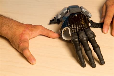 Finger and Partial Hand Prosthetic Options | Arm Dynamics