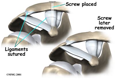 Acromioclavicular Joint Separation | Central Orthopedic Group