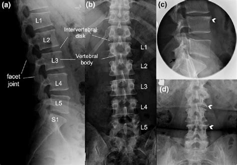 2 Osteoarthritis 2 . 1 Cervical and Lumbar Spondylosis | Semantic Scholar