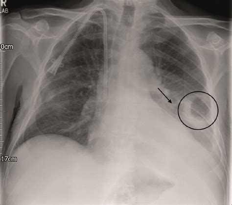 A man with a cavitating lung lesion | The BMJ