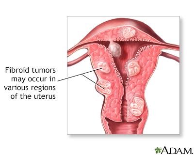 Abdominal mass Information | Mount Sinai - New York