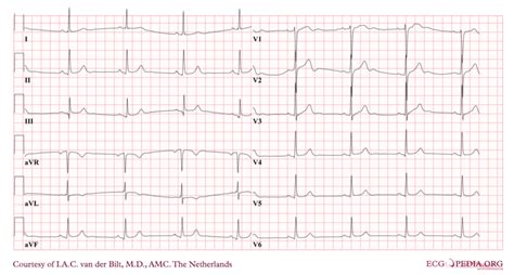 Sinus bradycardia electrocardiogram - wikidoc