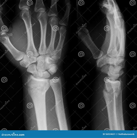 X-ray Image of Wrist Joint, AP and Lateral View. Stock Image - Image of ...