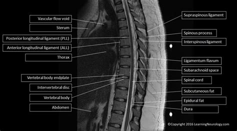 Ouille! 50+ Faits sur Ligamentum Flavum Mrt: Ligamentum flavum is an ...