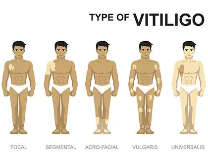 Is Vitiligo Treatment Necessary? - Dr. Batra’s®