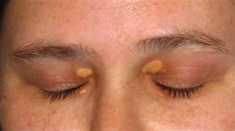 Xanthelasma | Yellow Cholesterol Patches Around Eyes Treatment | Mr ...