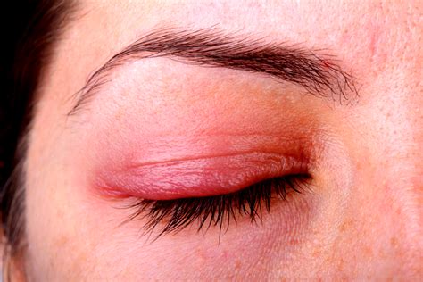 Ocular Rosacea - Causes, Symptoms & Treatment in Miami