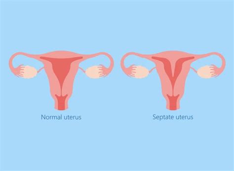 Septate Uterus: What It Is and How It Affects Pregnancy