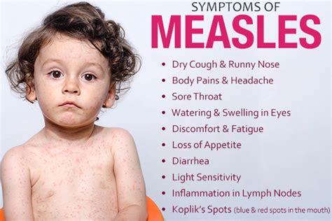 Measles: Types, Symptoms, Treatment, and Vaccinations