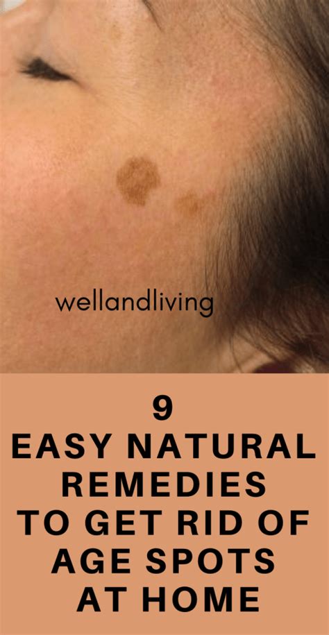 9 Easy Natural Remedies to Get Rid Of Age Spots at Home - Well and Living