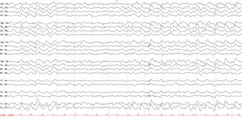 The Normal Asleep EEG