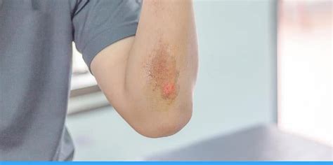 What Are The Difference Between Abrasion VS. Laceration?