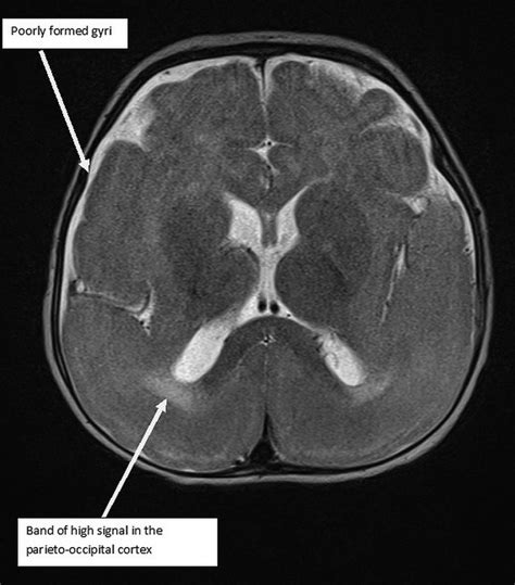 A case of lissencephaly in a 5-month-old infant | BMJ Case Reports