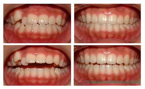 What to Expect Before and After Braces | Thomas Orthodontics