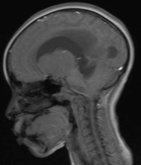 Pilocytic Astrocytoma | Consultant360