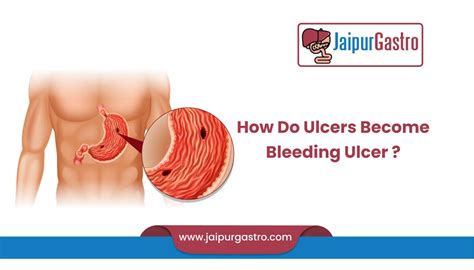 How Do Ulcers Become Bleeding Ulcer - Is it possible to prevent [2022]