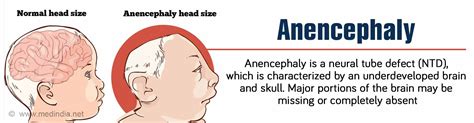 Anencephaly - Causes, Symptoms, Diagnosis and Treatment