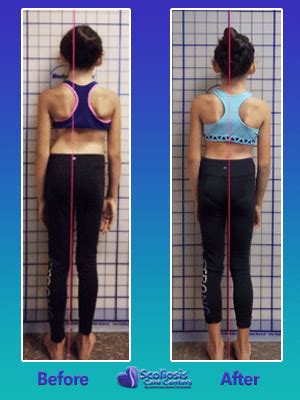 Scoliosis Posture Results - Scoliosis Care Centers