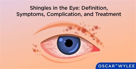 Shingles Symptoms Eye