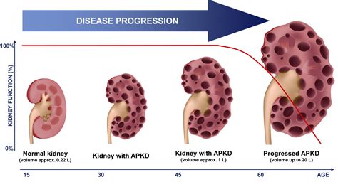 Study Shows Polycystic Kidney Disease Can Be Treated By Ketogenic Diet ...