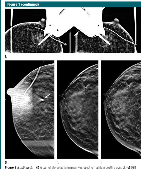 Digital breast tomosynthesis-guided vacuum-assisted breast biopsy ...