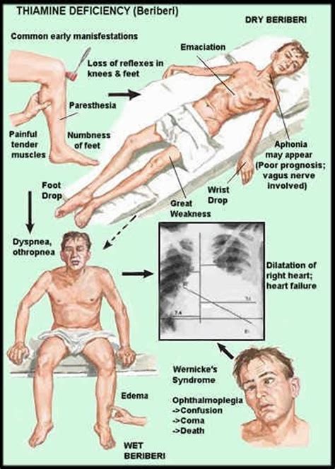 Thiamine deficiency, Beriberi, causes, symptoms, diagnosis, treatment ...