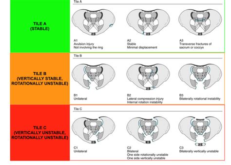 Classification of pelvic injury - RCEMLearning India