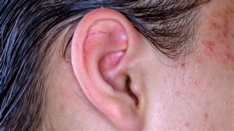 Causes And Treatment for Pimple in Ear: Know its Types And Home ...