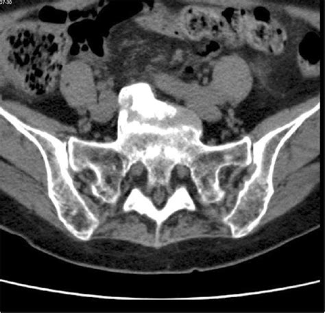 Transverse plane CT scan: sacral promontory | Download Scientific Diagram