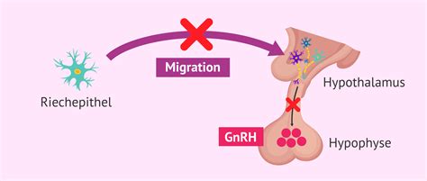 GnRH-Mangel beim Kallmann-Syndrom