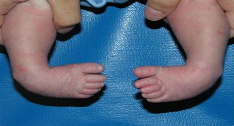 A Brief Discussion about Clubfoot – Causes and Treatment