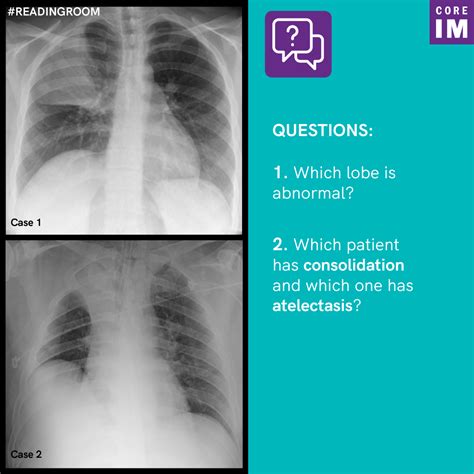 What is the difference between atelectasis vs. consolidation? | Core IM ...