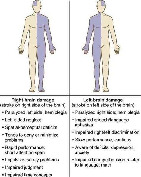 Right Hemiplegia - Cause, Symptoms, Treatment, Rehabilitation