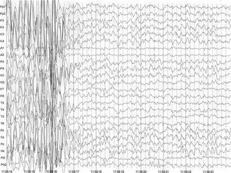 Normal Versus Abnormal Eeg