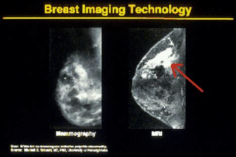 Understanding Breast Cancer and Mammograms | Negative and Positive Her2 ...