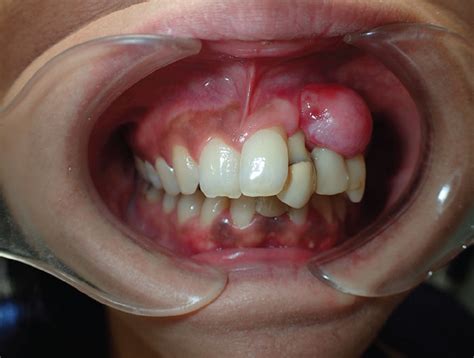 Fibrous epulis: A tumorlike gingival lesion | Cleveland Clinic Journal ...