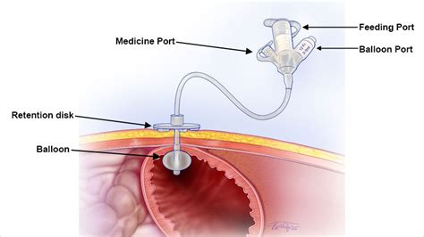 Gastrostomy Tubes (G Tube) Children's Hospital Of, 54% OFF