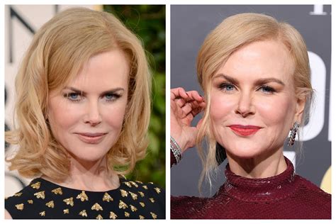 Nicole Kidman Displays 'Tell-Tale' Signs of Plastic Surgery