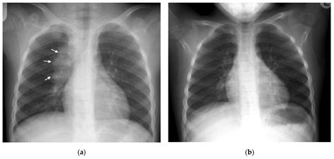 Tuberculosis X Ray Cavitation