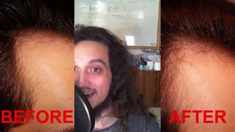 Finasteride Ru58841 And Minoxidil 10 Years Later Before After Results ...